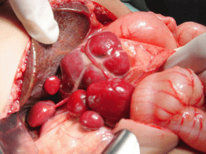 polysplenia