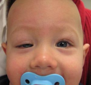 افتادگی پلک راست (پتوز-ptosis)