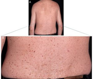 اختلالات پوستی ایجاد شده در TTD (ایجاد خشکی و لکه)
