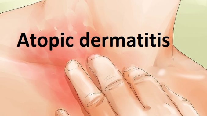 aid1493013-v4-728px-Treat-Dermatitis-Step-10-Version-3 (1)