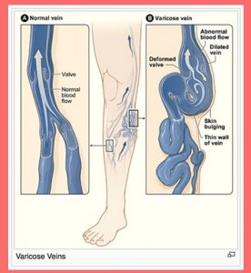 وریدهای واریسی-varicose veins