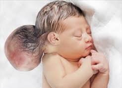آنسفالوسل-encephalocele