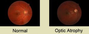 آتروفی بینایی-optic atrophy