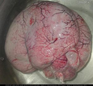 از بین رفتن شیارهای مغز، لیسنسفالی ( lissencephaly)