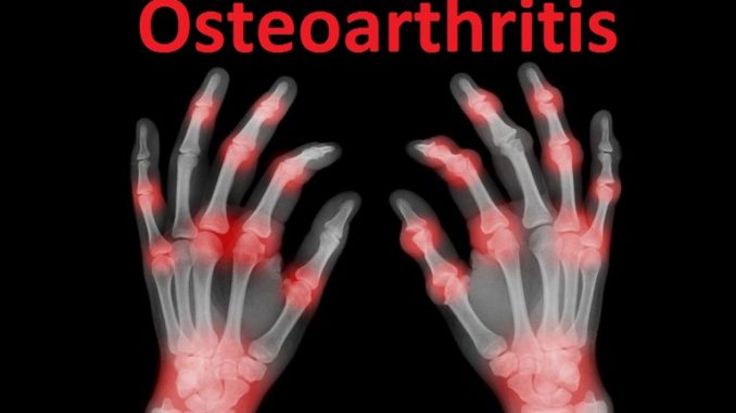 x-ray-of-painful-hands-991972390-5c04432846e0fb0001b497b2
