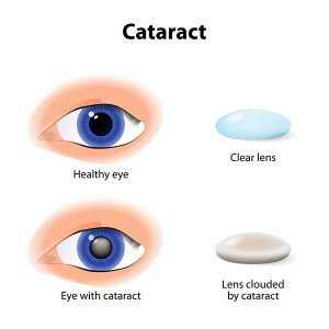 آب مروارید- cataracts