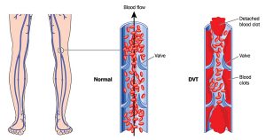 ترومبوز ورید عمقی (deep vein thrombosis) و یا DVT